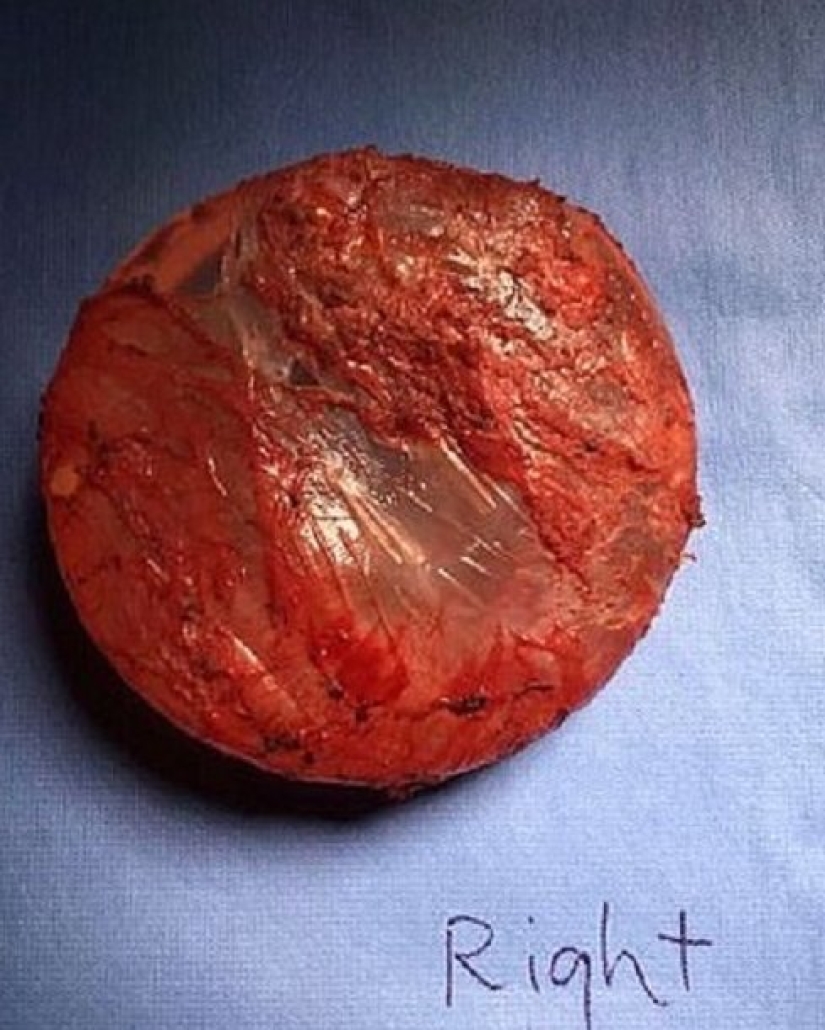 "Con ellos, mi vida se convirtió en un infierno": una mujer australiana contó por qué se deshizo de los implantes mamarios