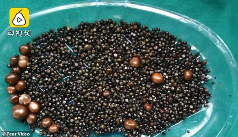 Dama de piedra: durante la operación, se extrajeron más de 2,000 cálculos biliares de la vesícula biliar de la mujer china