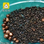 Dama de piedra: durante la operación, se extrajeron más de 2,000 cálculos biliares de la vesícula biliar de la mujer china Dama de piedra: durante la operación, se extrajeron más de 2,000 cálculos biliares de la vesícula biliar de la mujer china