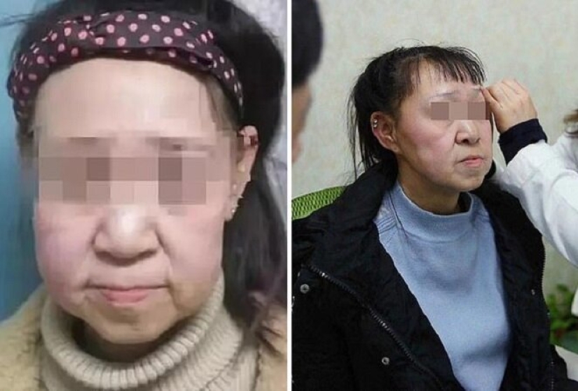 De abuela a niña: una mujer china de 15 años con rostro de anciana se sometió a una cirugía
