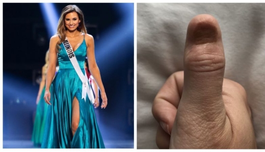 Deadly manicure: the beauty queen was diagnosed with cancer after nail extensions