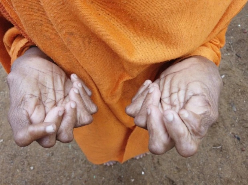 Dedos con abanico: una mujer con 31 dedos entró en el Libro Guinness de los Récords Dedos con abanico: una mujer con 31 dedos entró en el Libro Guinness de los Récords