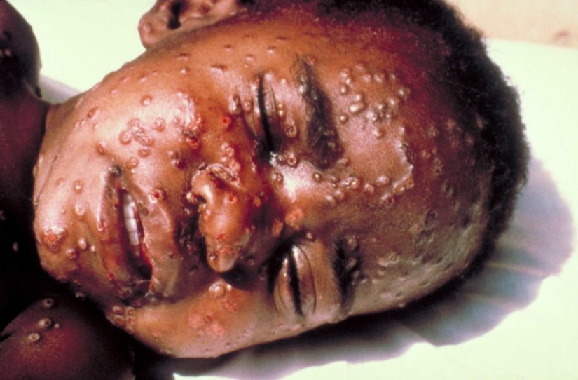 Died of smallpox in 1851: the identity of the girl buried in an iron coffin in New York is established