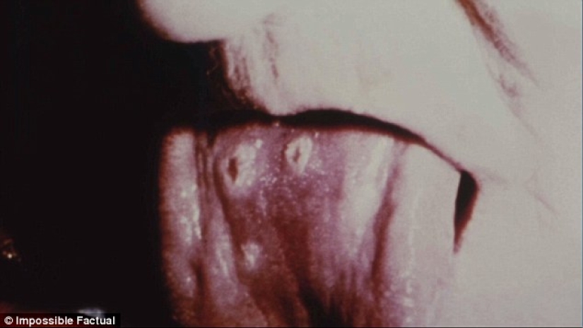 Died of smallpox in 1851: the identity of the girl buried in an iron coffin in New York is established