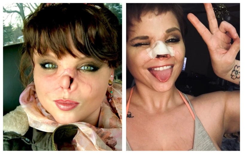 Disfigured love: a pit bull bit off a girl's nose, but she forgave him and continues to cuddle with dogs Disfigured love: a pit bull bit off a girl's nose, but she forgave him and continues to cuddle with dogs