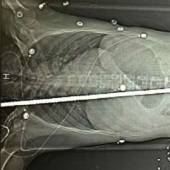 El constructor sobrevivió milagrosamente después de ser atravesado por una barra de refuerzo de dos metros