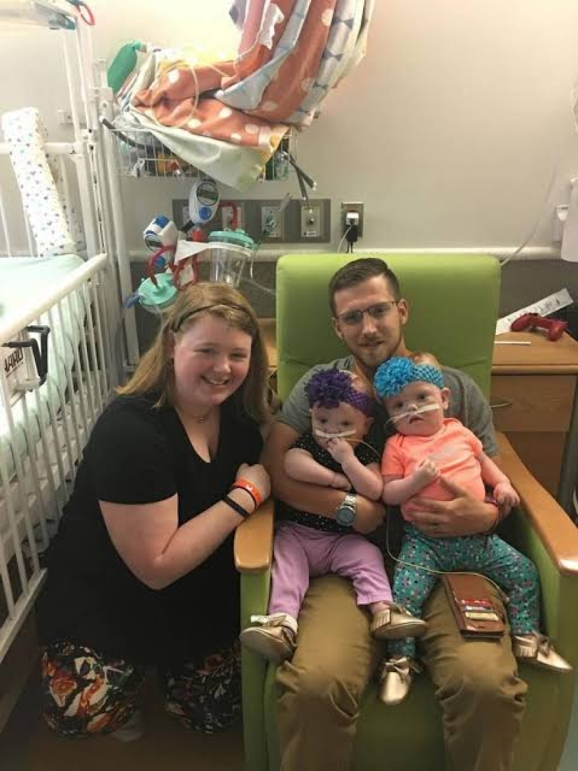 El derecho a la vida: gemelos siameses de 1,5 años, nacidos con la cabeza fusionada, se recuperaron de una operación complicada y se regocijan todos los días