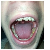 El ingeniero de energía que destruyó los dientes y la vida: el joven de 21 años perdió la sonrisa y los sueños, bebiendo regularmente una bebida vigorizante