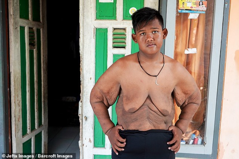 El niño más gordo del mundo, que pesaba 192 kg a la edad de 10 años, perdió más del doble de peso