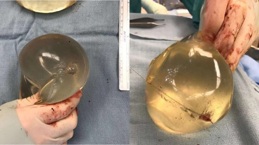 El pecho de silicona salvó la vida de su amante al detener una bala