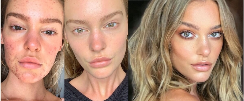 El resultado es obvio: el modelo Sports Illustrated se deshizo del acné, gracias a la nutrición y la meditación