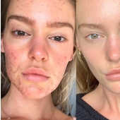 El resultado es obvio: el modelo Sports Illustrated se deshizo del acné, gracias a la nutrición y la meditación El resultado es obvio: el modelo Sports Illustrated se deshizo del acné, gracias a la nutrición y la meditación