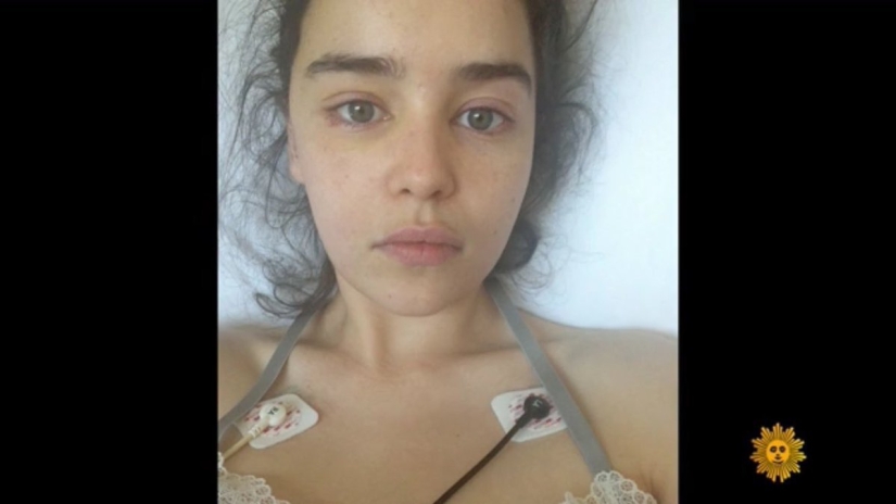 En la web aparecieron fotos de Emilia Clarke después de un derrame cerebral y una trepanación craneal En la web aparecieron fotos de Emilia Clarke después de un derrame cerebral y una trepanación craneal