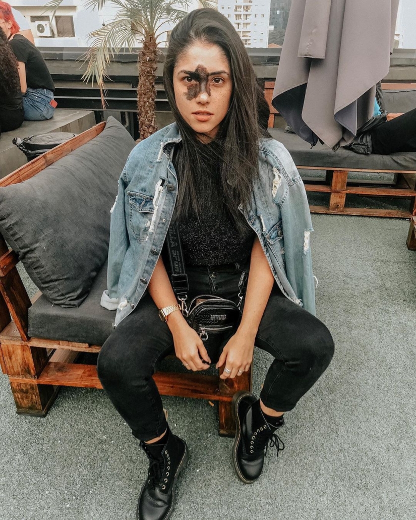 Everyone mocked this girl because of her birthmark, and she took and became a model Everyone mocked this girl because of her birthmark, and she took and became a model