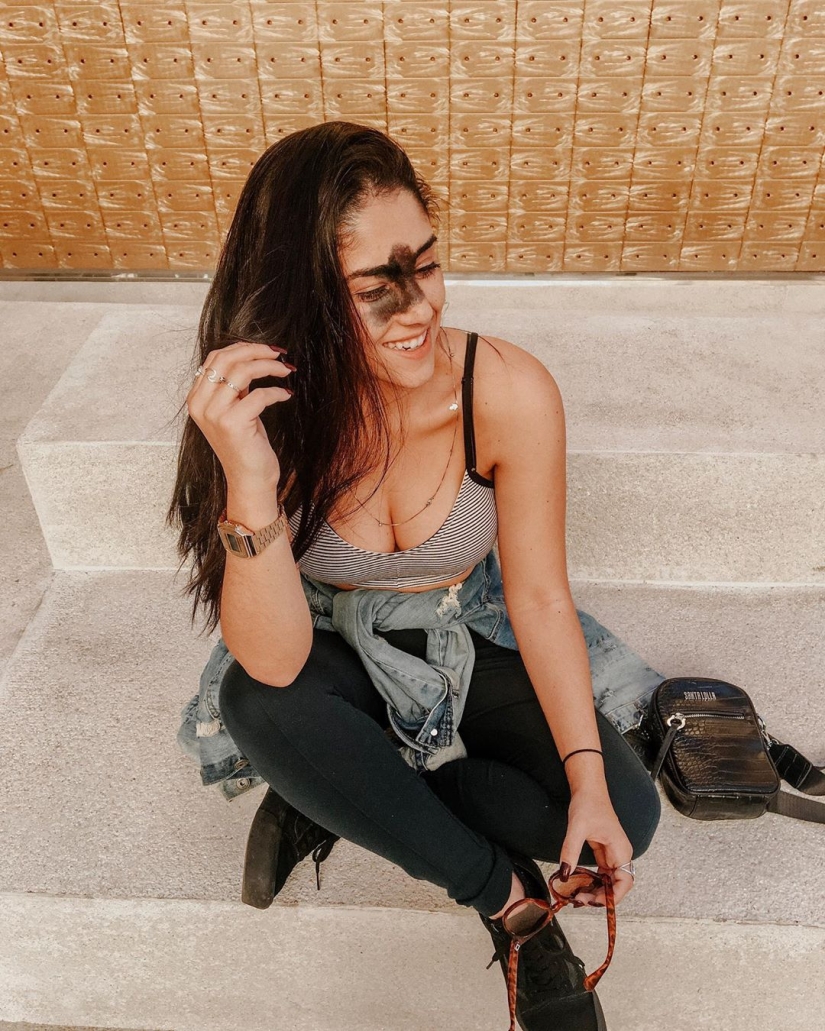 Everyone mocked this girl because of her birthmark, and she took and became a model Everyone mocked this girl because of her birthmark, and she took and became a model