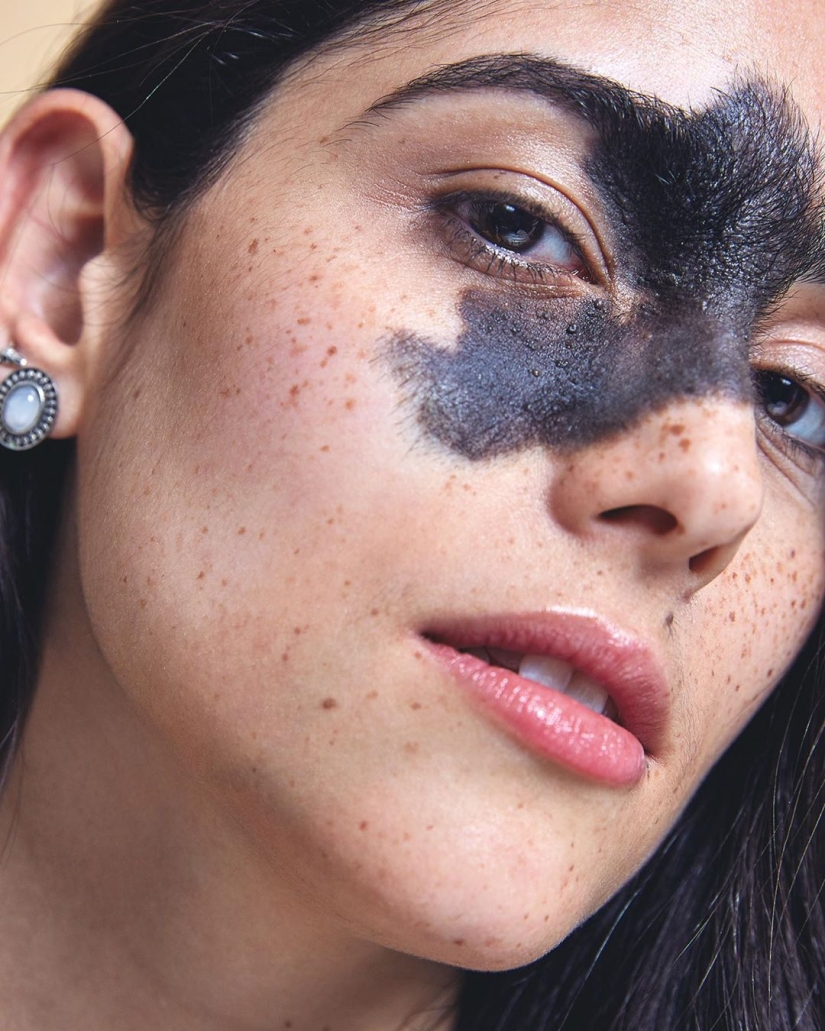 Everyone mocked this girl because of her birthmark, and she took and became a model Everyone mocked this girl because of her birthmark, and she took and became a model