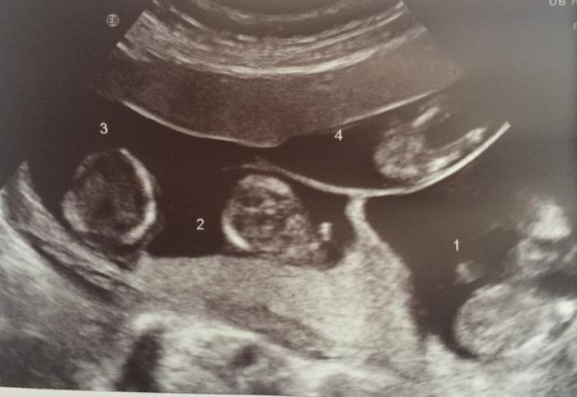 Felicidad multiplicada por 4 y preocupaciones divididas por 2: las matemáticas de criar cuatrillizos maravillosos
