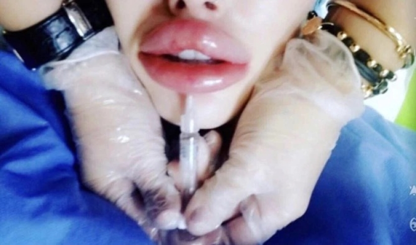 Fetish model almost died during plastic surgery on her vagina