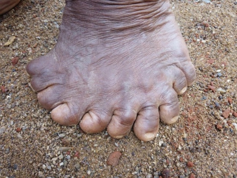 Fingers with a fan: a woman with 31 fingers got into the Guinness Book of Records Fingers with a fan: a woman with 31 fingers got into the Guinness Book of Records