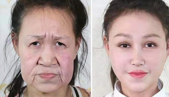 From grandmother to girl: a 15-year-old Chinese woman with an old woman's face underwent surgery