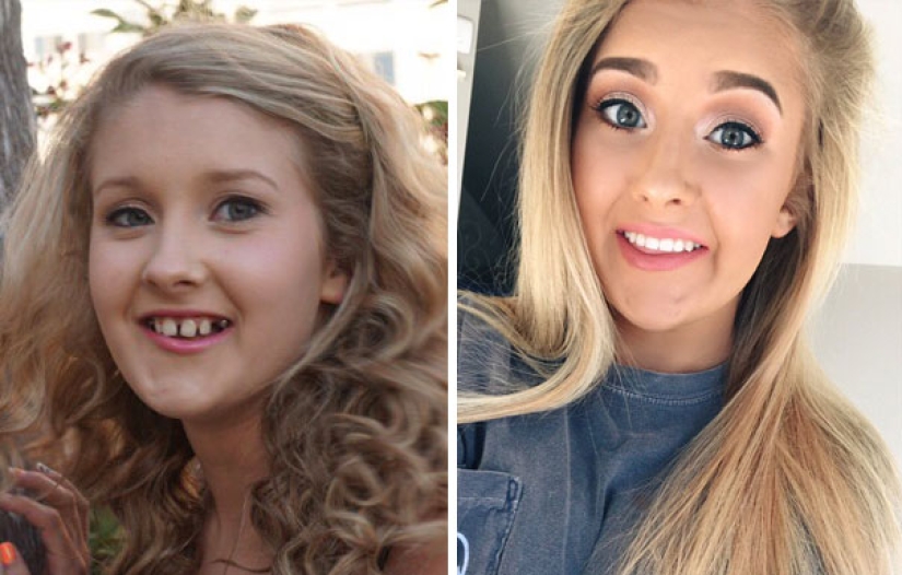 Here's how radically braces change a smile and life