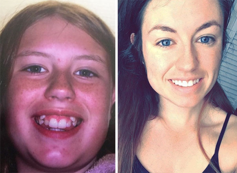 Here's how radically braces change a smile and life