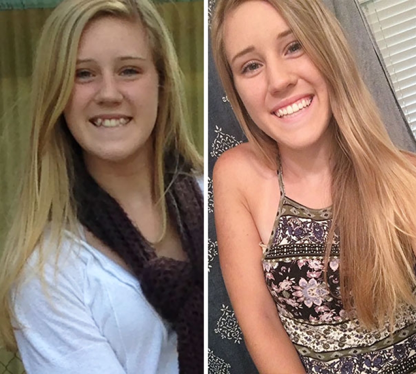Here's how radically braces change a smile and life