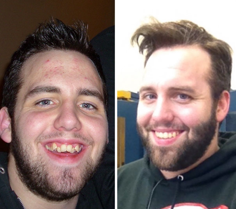 Here's how radically braces change a smile and life