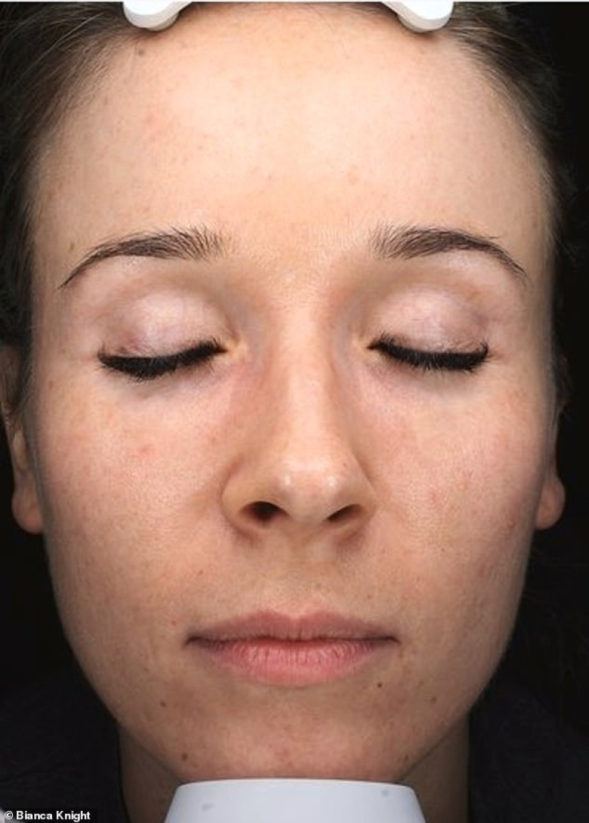How a phone and a computer age the skin: a young woman was horrified by the effects of radiation on her face