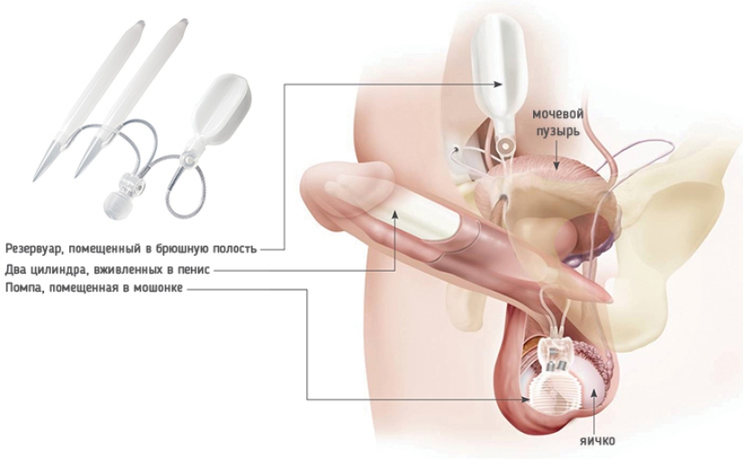 How does a man with a bionic penis live