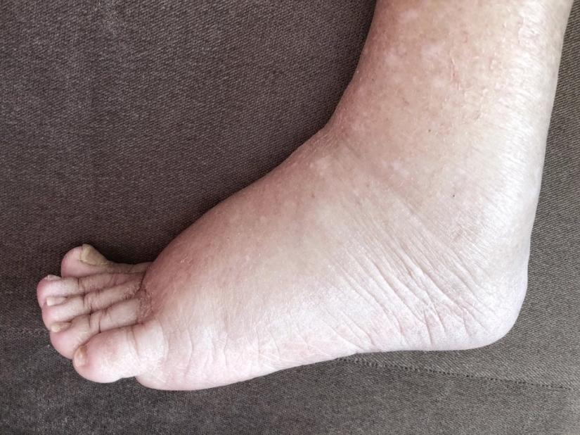 How the feet display the state of health — 8 signals about serious diseases How the feet display the state of health — 8 signals about serious diseases