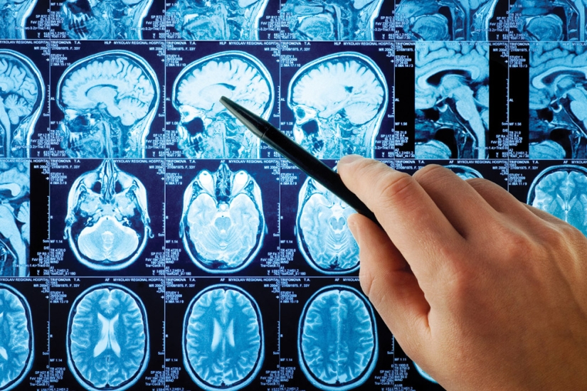 "Icons jump out of the monitor" and other strange signs of Alice in Wonderland syndrome "Icons jump out of the monitor" and other strange signs of Alice in Wonderland syndrome