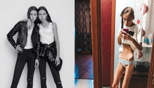 In the captivity of Kashchey: deadly thinness almost killed twin sisters from Russia In the captivity of Kashchey: deadly thinness almost killed twin sisters from Russia