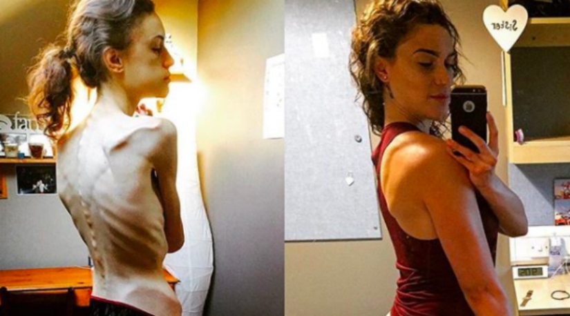"Instagram saved my life": anorexic woman wanted to live thanks to photos of girls who defeated the disease