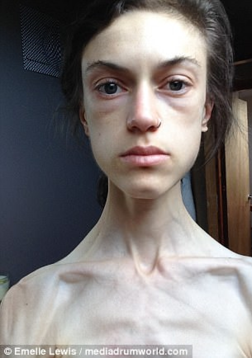 "Instagram saved my life": anorexic woman wanted to live thanks to photos of girls who defeated the disease