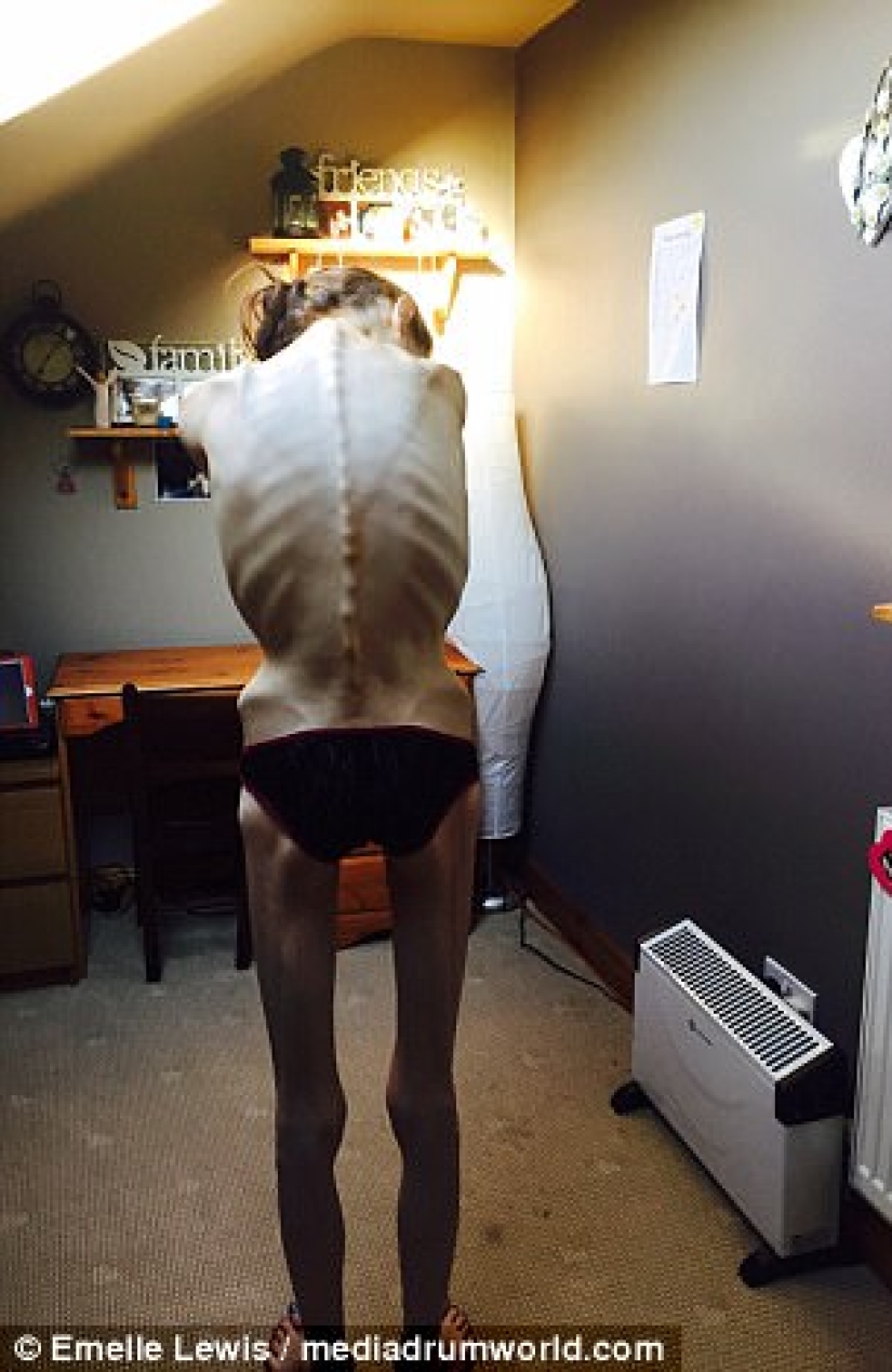 "Instagram saved my life": anorexic woman wanted to live thanks to photos of girls who defeated the disease