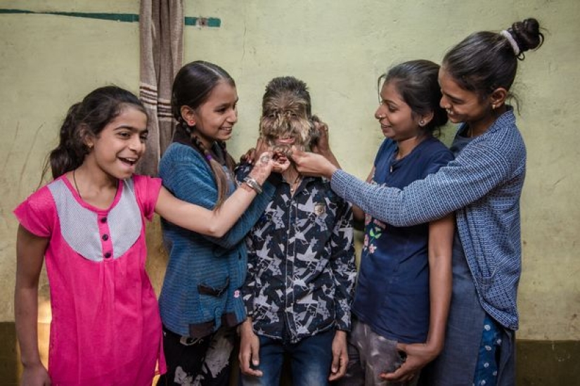 Kind and fluffy: A 13-year-old boy from India suffers from "werewolf syndrome"