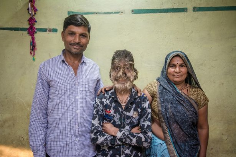 Kind and fluffy: A 13-year-old boy from India suffers from "werewolf syndrome"