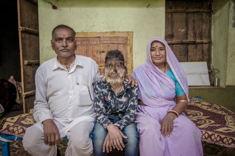 Kind and fluffy: A 13-year-old boy from India suffers from "werewolf syndrome"