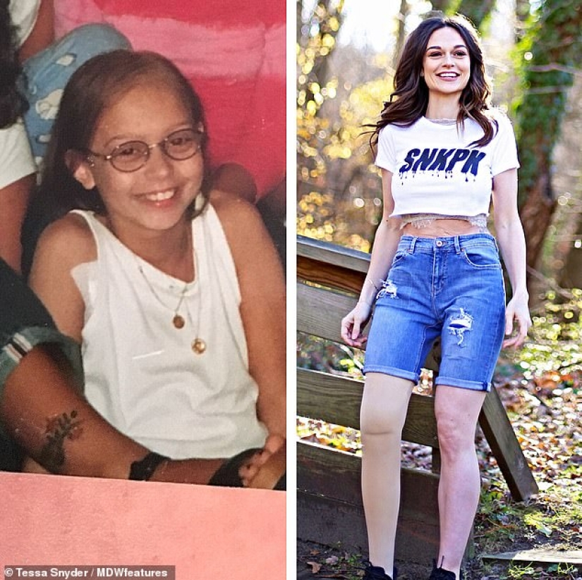 "La amputación ya es mejor": una niña perdió una pierna a los 11 años, se convirtió en modelo y ahora inspira a otros