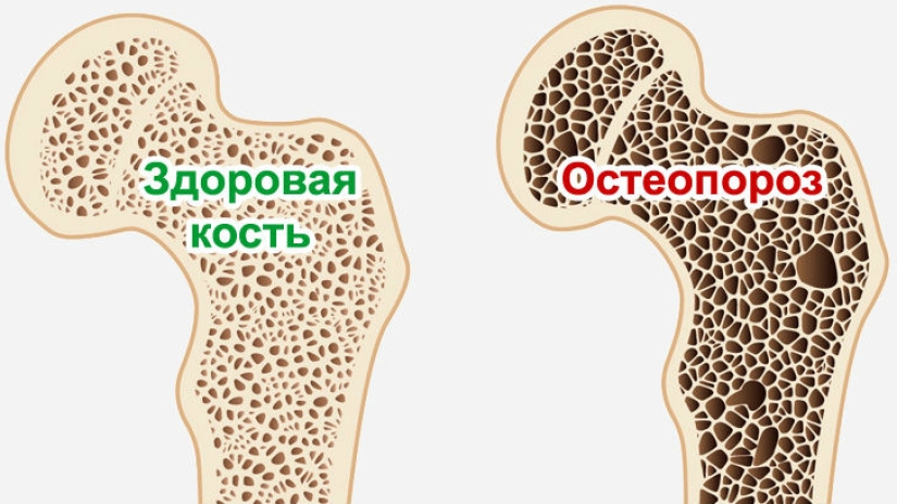 La mujer china "envejeció" 30 años debido al hecho de que amaba mucho el café