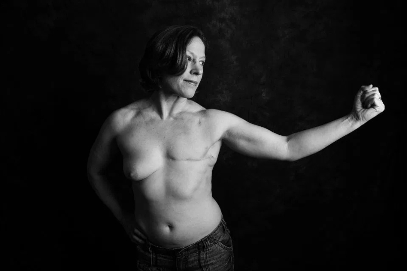 La verdad desnuda: Pacientes valientes se enfrentan al cáncer mostrando cicatrices en el conmovedor proyecto fotográfico de Ami Barwell