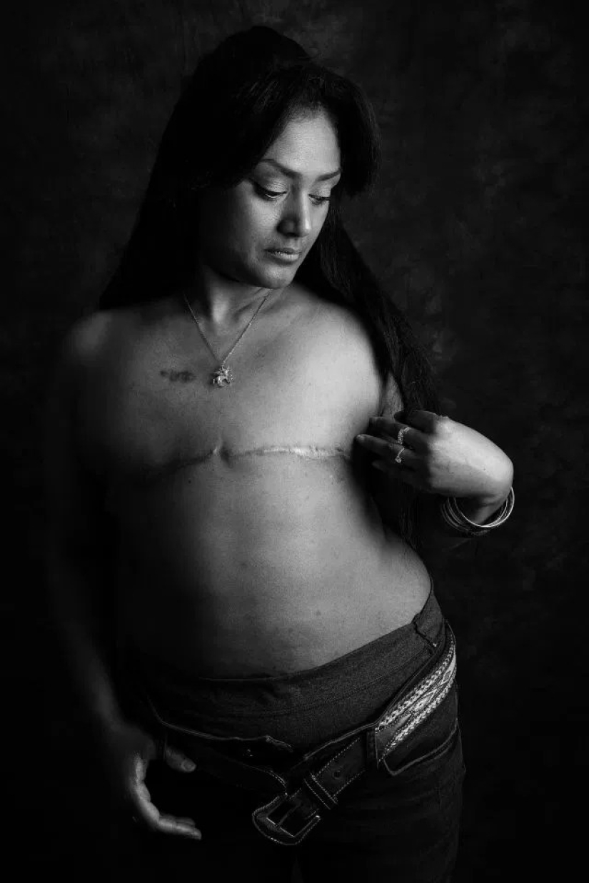 La verdad desnuda: Pacientes valientes se enfrentan al cáncer mostrando cicatrices en el conmovedor proyecto fotográfico de Ami Barwell