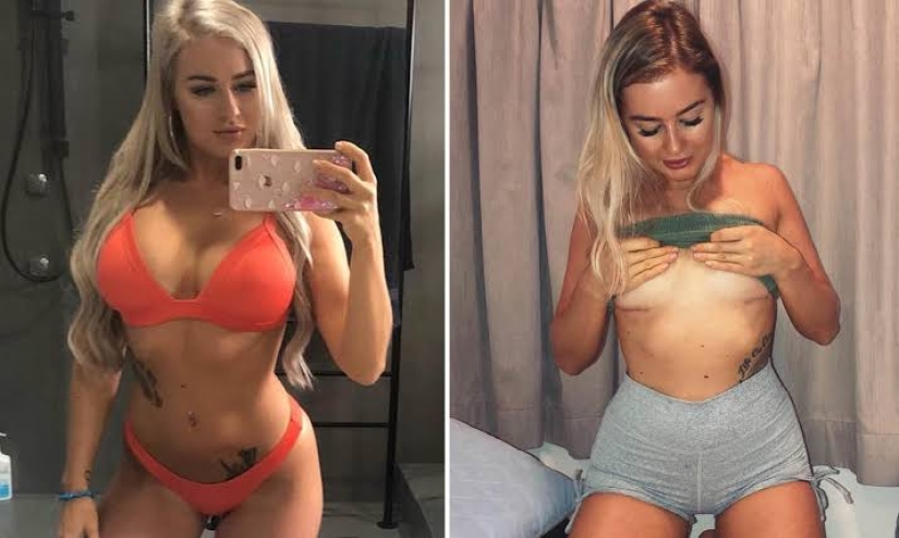 Like a stone from the soul: an Australian woman removed silicone from her breasts because it interfered with her sex life