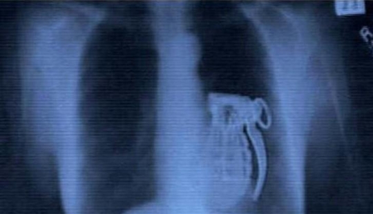 Los objetos más increíbles que se han encontrado en el cuerpo humano Los objetos más increíbles que se han encontrado en el cuerpo humano