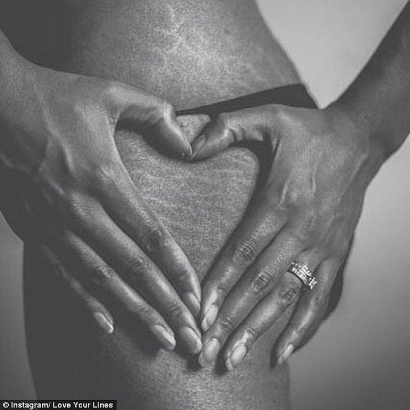 Love your stretch marks