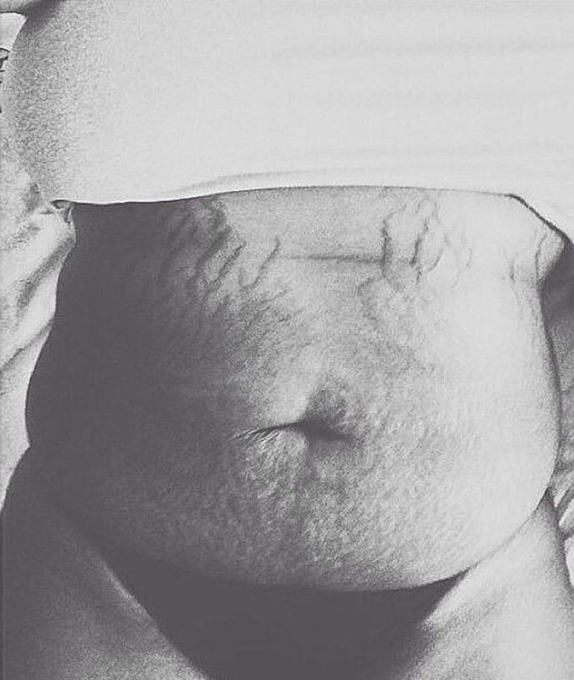 Love your stretch marks
