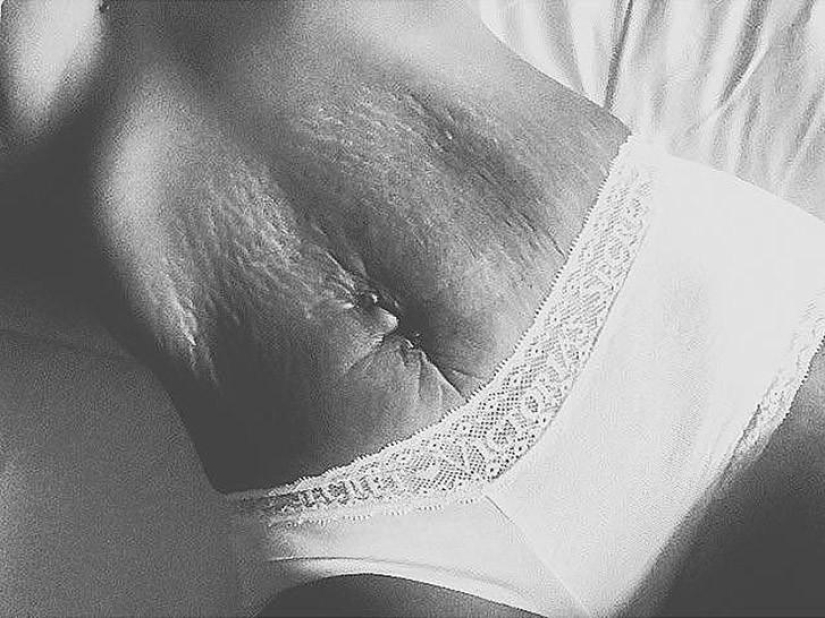 Love your stretch marks