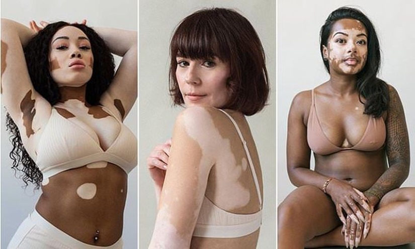 Models with vitiligo: beautiful and amazing