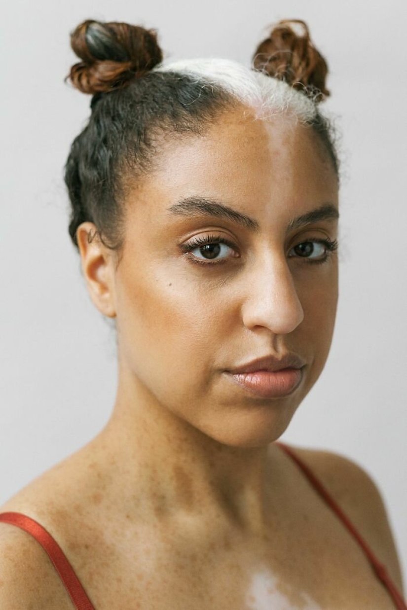 Models with vitiligo: beautiful and amazing
